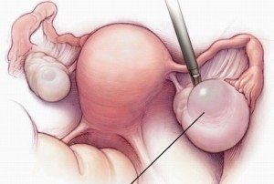 Okai petefészek ciszták (dermoid stb típus) - jobbra vagy balra (előfordulás) Az okok a petefészek ciszták (dermoid és más típusú) - balra vagy jobbra