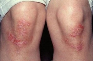 Psoriasis lábakon