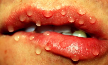 Buborékok a szájban nyálkahártya átlátszó és fehér, fotó és a kezelés