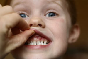 Buborékok a szájban nyálkahártya átlátszó és fehér, fotó és a kezelés