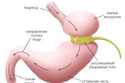 Kitágult gyomor (viselkedése a gyomor) kitágult gyomor
