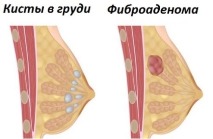 Egy csomó a mellben a nők - ez lehet az oka, a tünetek, a kezelés