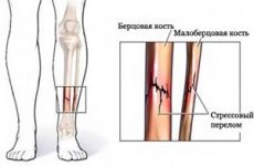 Tünetek, hatások és a kezelés a törések a coccyx