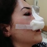 Hogyan tartja duzzanat az orr orrplasztika után képeket és az értékeléseket