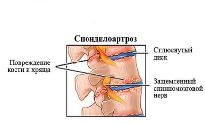 Spondylarthrosis háti gerinc kezelésére, a tünetek, okok