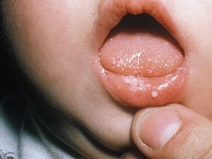 Stomatitis csecsemők (egy tojás) Stomatitis csecsemők