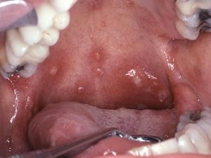 Stomatitis csecsemőknél (stomatitis) Stomatitis csecsemők