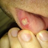 Stomatitis csecsemőknél (kicsi) Stomatitis csecsemők