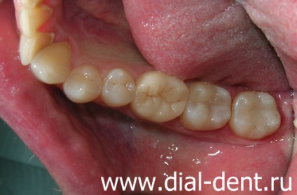 Időben diagnózis fogszuvasodás panoráma fotó
