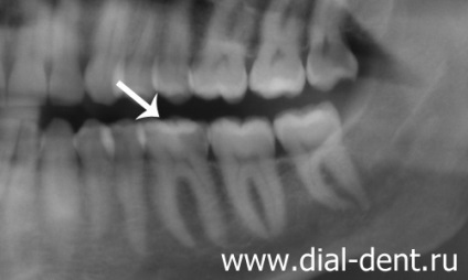 Időben diagnózis fogszuvasodás panoráma fotó