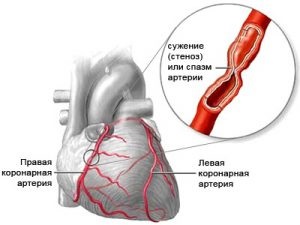 Tachycardia, angina kezelésében különbözik, a tünetek