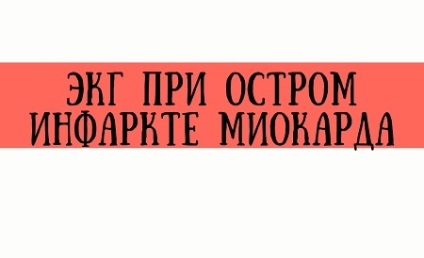 Lokális diagnózisa miokardiális infarktus (topikális diagnózisa miokardiális infarktus) Lokális diagnózisa szívinfarktus