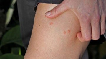 A harapás egy szúnyog - mi kend (szúnyogok) A harapás egy szúnyog - mi kend
