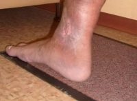 A vénás láb ekcéma - Kezelés, okai, tünetei