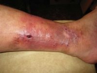 A vénás láb ekcéma - Kezelés, okai, tünetei