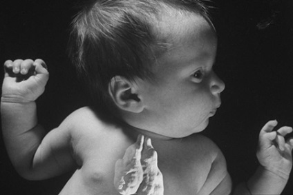 A csecsemőmirigy (thymus) gyermekek általános jellemzője betegségek és kezelések