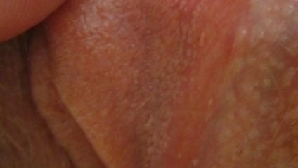 Висипання на статевих губах фото, причини і небезпечні симптоми, шкірні хвороби