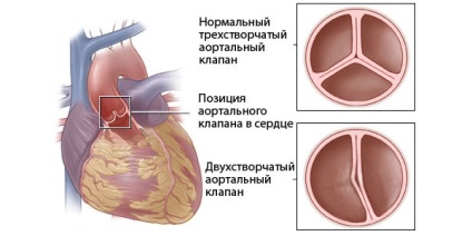 Veleszületett szívbetegség újszülöttek okok és osztályozás