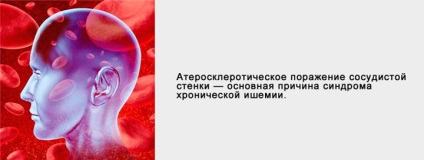 Krónikus agyi ischaemia, mi az, a tünetek és a kezelés (az agy) Krónikus agyi ischaemia, mi ez, tünetei és kezelése