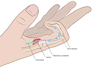 Reteszelő ujj Clinic és diagnosztika