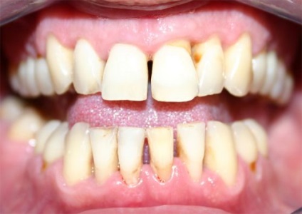Fogkrém fogágybetegség, amely jobb, hogyan kell alkalmazni