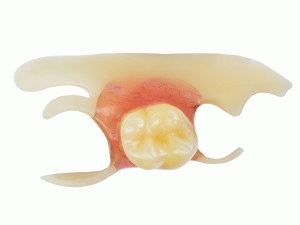 Műfogsorok Azonnali pillangó tervezési funkciók, egységár (azonnali) Azonnali műfogsorok pillangó, konstrukciók, ármeghatározás