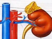 Adenoma a vese, hogy ez, a tünetek és a kezelés (adenoma) Adenoma a vese, hogy ez, a tünetek és a kezelés