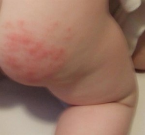 Allergia bobotik csecsemők tünetei és kezelése