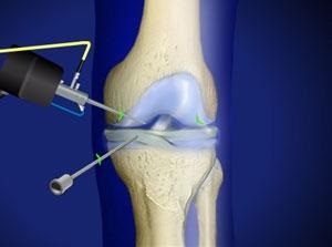 Térd arthroscopy - hatékony kezelési és diagnosztikai módszerek