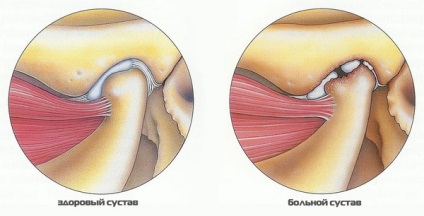 Osteoarthritis az állkapocsízület tünetek és a kezelés