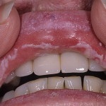 Fehér folt a fogíny fáj