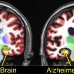 Alzheimer ha örökölték-e vagy sem