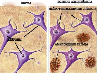 Alzheimer-kór - okozza a két örökölt (telt) Alzheimer-kór - okoz, mint az örökletes