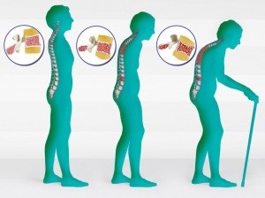 Központ csontritkulás (osteoporosis) csontritkulás Center