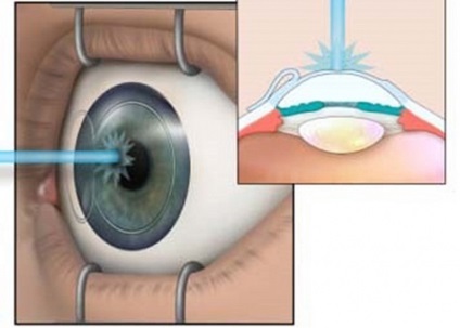 A veszélyes lézeres látásjavító eljárás előnyei és hátrányai