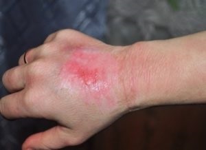 Mi a teendő, ha a buborék kipukkanása után az égési (utána) Mi a teendő, ha a buborék kipukkanása után az égés