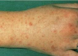 Mi meningococcus vérfertőzés (lehet menteni a beteg életét) Mi a meningococcus septicaemia