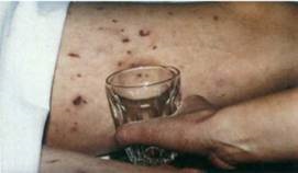 Mi meningococcus vérfertőzés (vérmérgezésben) Mi a meningococcus septicaemia