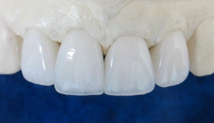 Цирконієві коронки на передні зуби відгуки пацієнтів, детальний огляд