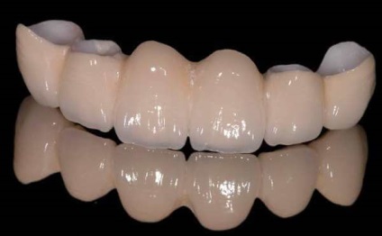 Цирконієві коронки на передні зуби відгуки пацієнтів, детальний огляд