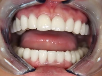 Cirkónium koronák az elülső fogak beteg beszámolók, részletes áttekintést