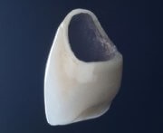 Cirkónium koronák az elülső fogak beteg beszámolók, részletes áttekintést