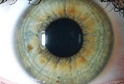 Betegségek diagnosztizálása a szem írisz