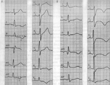 Az elektrokardiogram akut miokardiális infarktus