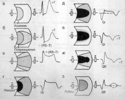 Az elektrokardiogram akut miokardiális infarktus