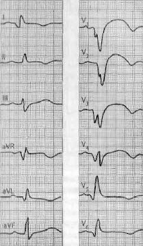 Az elektrokardiogram akut miokardiális infarktus