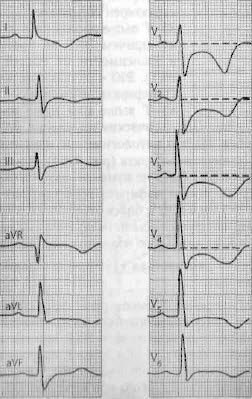 Az elektrokardiogram akut miokardiális infarktus