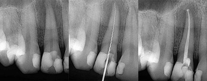 Endodontic kezelésére fog ez microoperation a gyökérkezelés