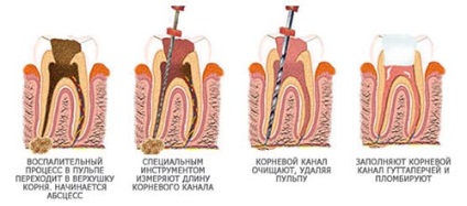 Endodontic kezelésére fog ez microoperation a gyökérkezelés