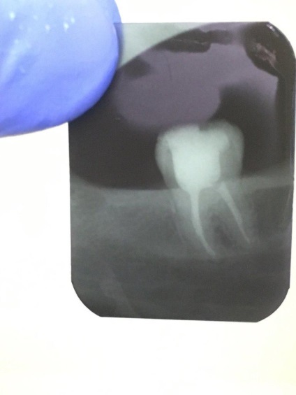 Endodontic kezelésére bölcsességfog - terápia - hírek és cikkek a fogászatban -